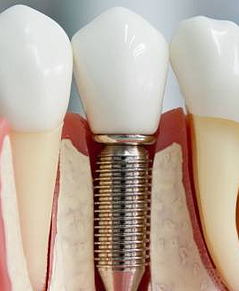 Дентальная имплантация